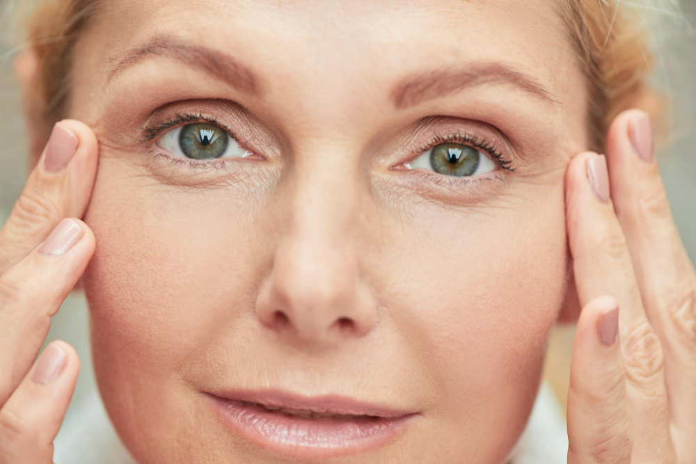 Lid Definition with Upper Blepharoplasty in Raleigh