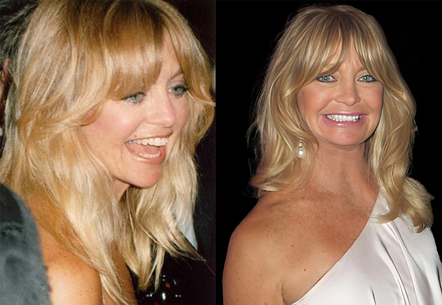 Goldie Hawn Facelift
