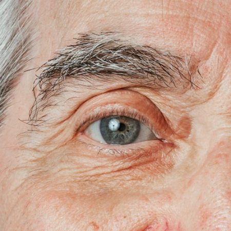 Canthopexy-Canthoplasty-03